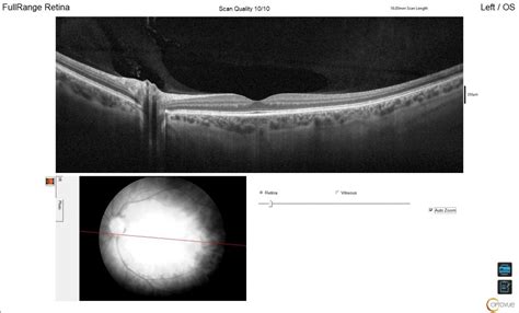 dijagnostika retina ghetaldus.